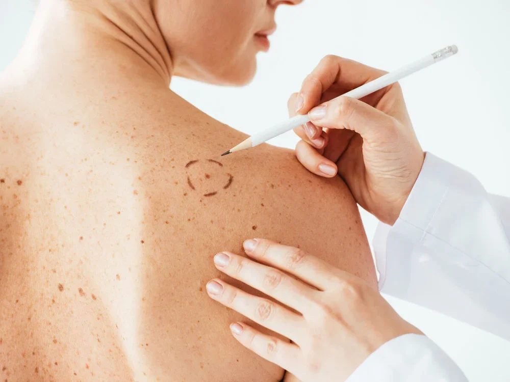 Campanha Euromelanoma alerta para sinais de cancro da pele e a importância do diagnóstico precoce.